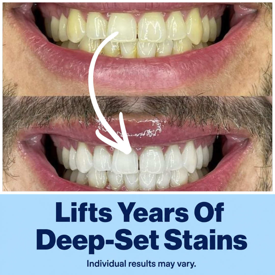 Teeth Whitening Strips